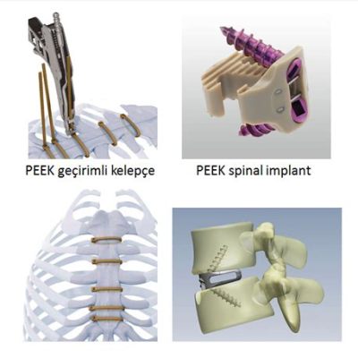  Nitinol: Biyo uyumlu Üstün Esnekliğin Şaşırtıcı Dünyası!